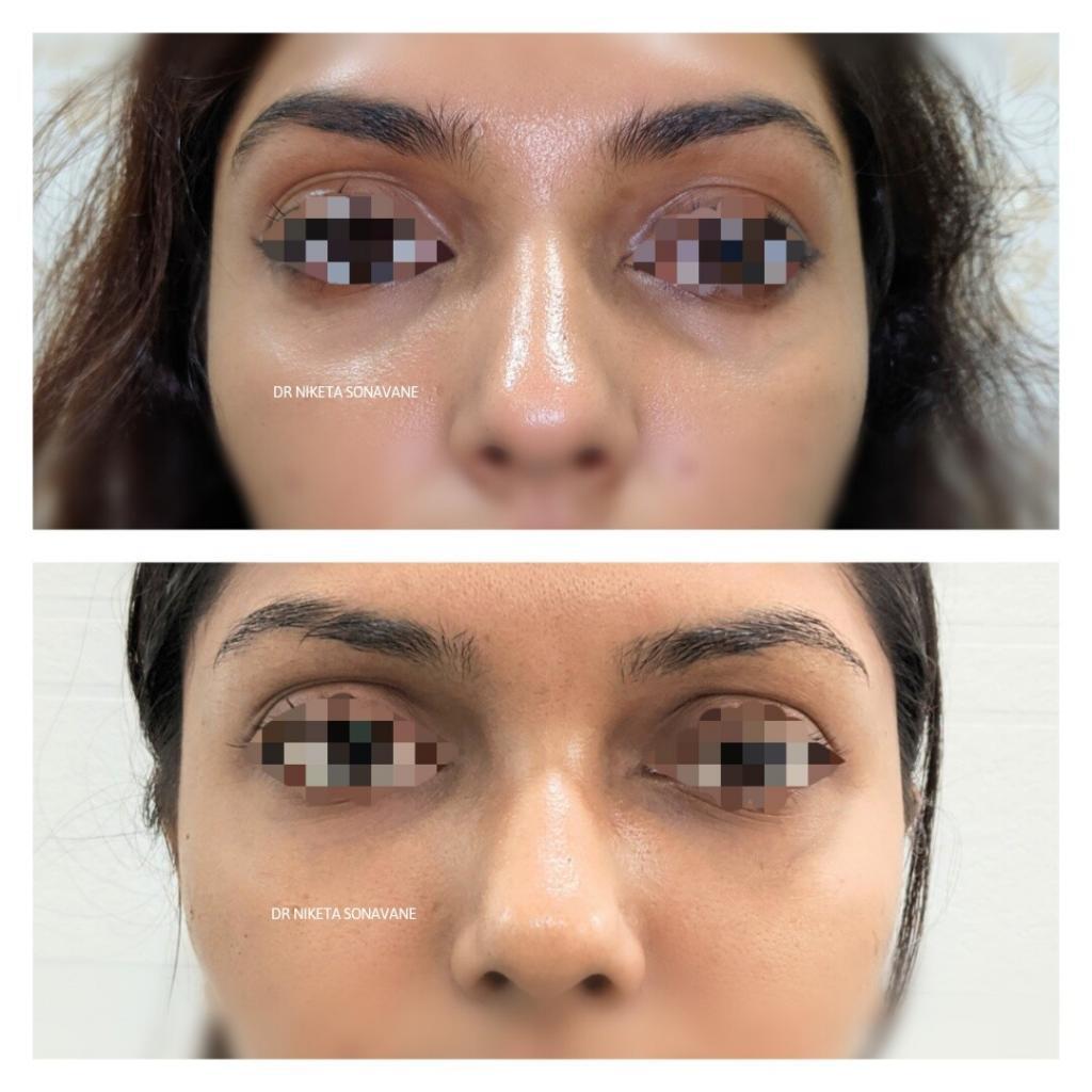 under eye fillers in Mumbai before after results, dark circles treatment in Mumbai, dermal fillers for dark circles in Mumbai