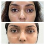 under eye fillers in Mumbai before after results, dark circles treatment in Mumbai, dermal fillers for dark circles in Mumbai