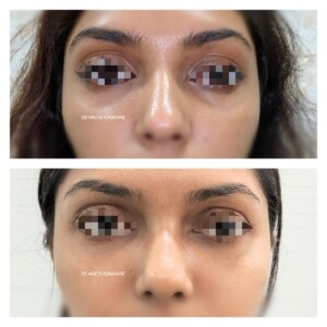 Dark Circles Treatment In Mumbai Cost