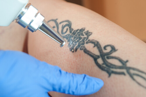 7. Laser Tattoo Removal Cost in Philadelphia - wide 2