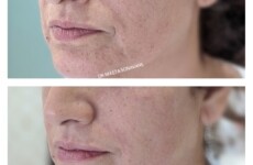 skin tightening treatment in Mumbai, best Dermatologist in Mumbai, skin tightening treatment before and after photos, cost of skin tightening treatment in mumbai, best Dermatologist in Mumbai, before and after photos