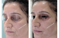 best Dermatologist in Mumbai, dermal fillers in Mumbai before and after photos
