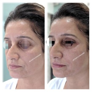best Dermatologist in Mumbai, dermal fillers in Mumbai before and after photos