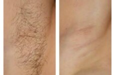 Laser hair removal in Mumbai, laserhair removal cost in mumbai