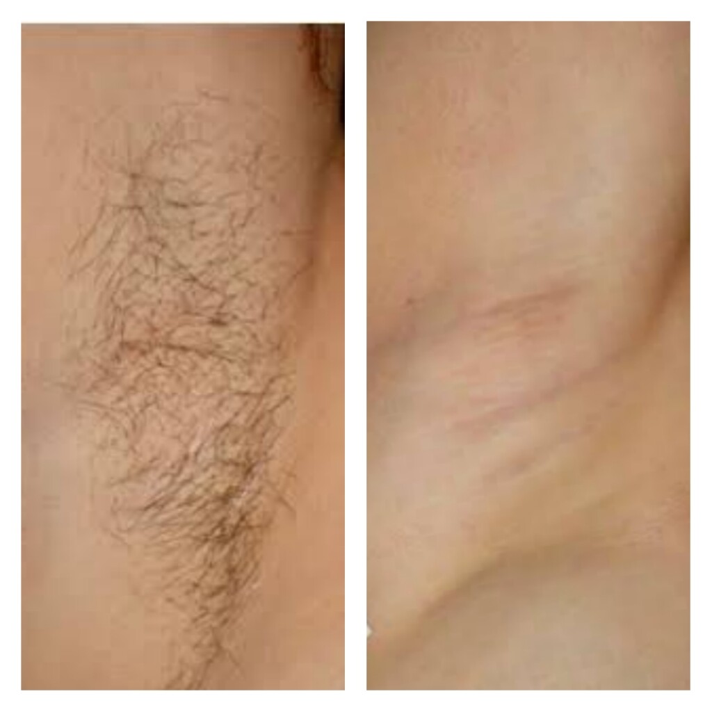 Laser hair removal in Mumbai, laserhair removal cost in mumbai