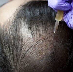hair loss treatment in mumbai