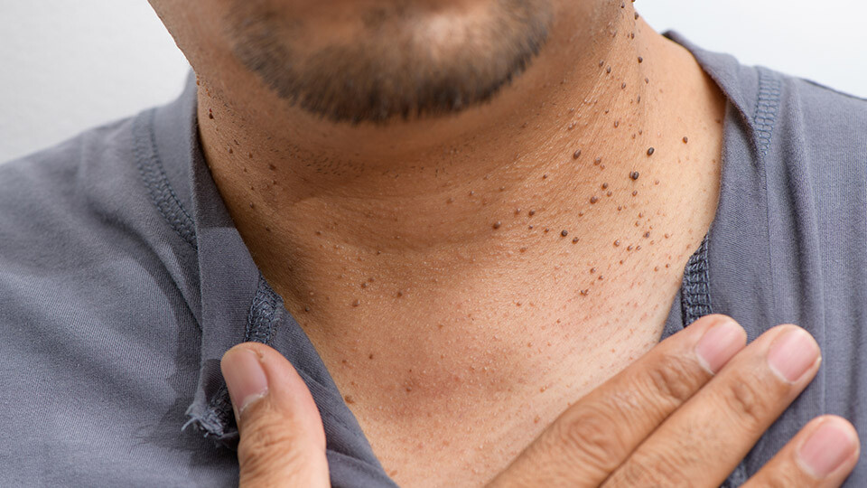 skin tags, skin tag removal mumbai, best dermatologist in Mumbai Dr Niketa Sonavane