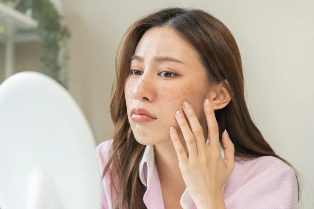 best melasma treatment in mumbai with top dermatologist Dr. Niketa Sonavane at Ambrosia Aesthetics, Mumbai